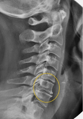 Osteochondróza krčnej chrbtice na x -roy